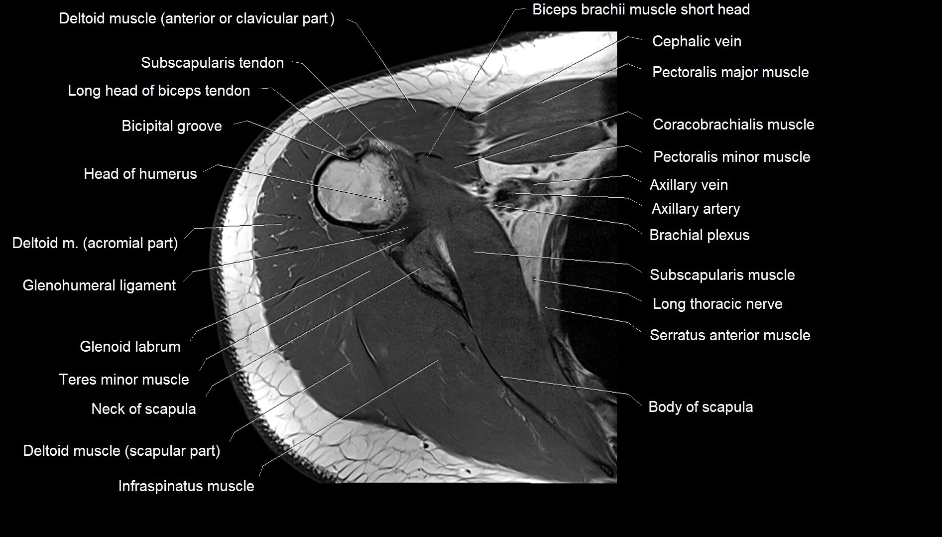 Shoulder cross sectional anatomy MRI 3T axial image 25.webp